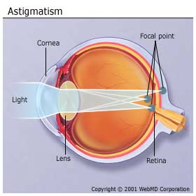 basics_astigmatism_diagram | Nutfield Eye Associates